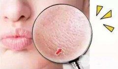 臉部毛孔粗怎么辦~|三招助你攻破難關(guān) 重拾靚麗青春