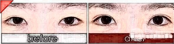 雙眼皮修復(fù)手術(shù)雙眼皮消退
