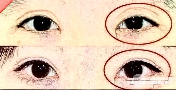 雙眼皮修復(fù)手術(shù)雙眼皮兩側(cè)不一樣