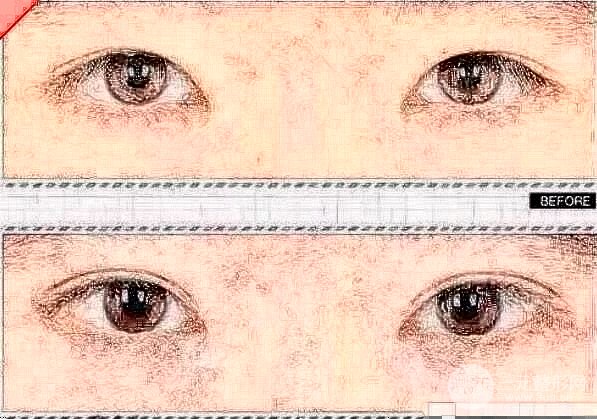 雙眼皮修復(fù)手術(shù)傷疤明X