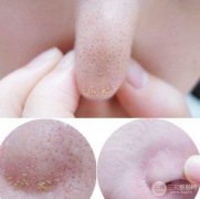毛孔粗有黑頭怎么辦 科普篇