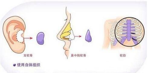 耳軟骨墊鼻尖