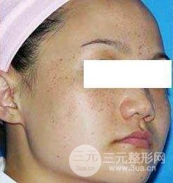 復(fù)合彩光祛痘果