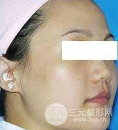 復(fù)合彩光祛痘案例