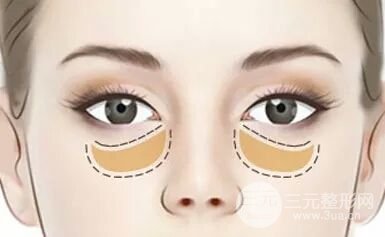 吸脂去眼袋的副作用