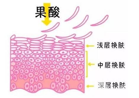 果酸換膚一次有用嗎