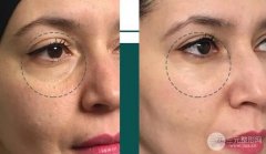 成都有黑眼圈怎么消除 常熬夜的必須看