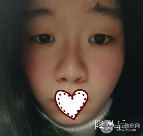 硅膠隆鼻要多少錢