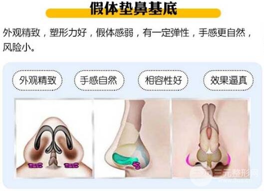 假體墊鼻基底手術(shù)原理