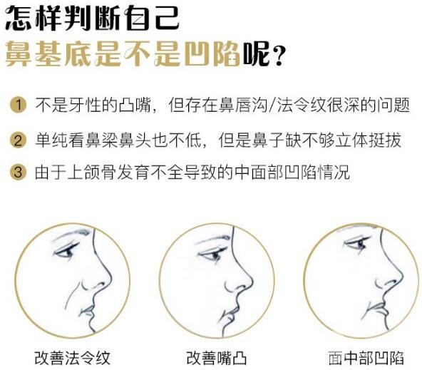 假體墊鼻基底多少錢？貴不貴