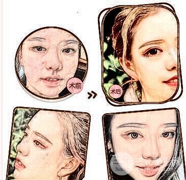 全割雙眼皮案例