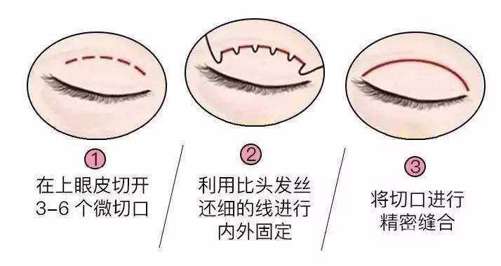 定點(diǎn)雙眼皮手術(shù)原理