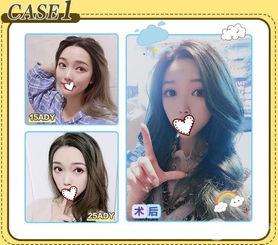 定點(diǎn)雙眼皮多少錢 可以保持多久？