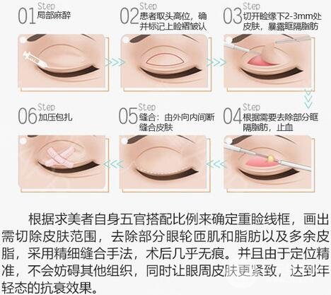 切開(kāi)雙眼皮手術(shù)原理簡(jiǎn)介