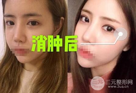 切開(kāi)雙眼皮多久消腫恢復(fù)自然？