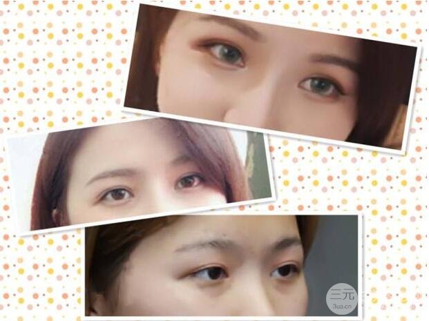 切開雙眼皮多久可以恢復(fù)自然微創(chuàng) 案例圖