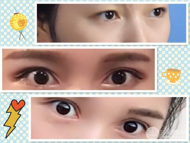 切開雙眼皮多久可以恢復(fù)自然