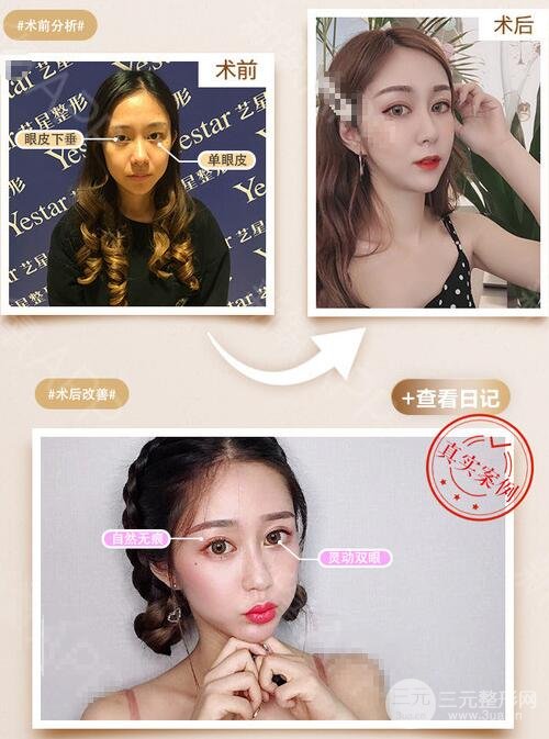 切開雙眼皮案例圖