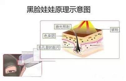 盤點一下黑臉娃娃價格，一療程費用詳情！