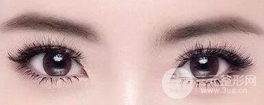 雙眼皮修復(fù)恢復(fù)期多久？具體的恢復(fù)時(shí)間揭秘~