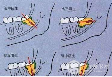 華西口腔醫(yī)院拔牙多少錢