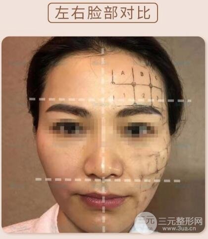 熱瑪吉除皺果對(duì)比圖