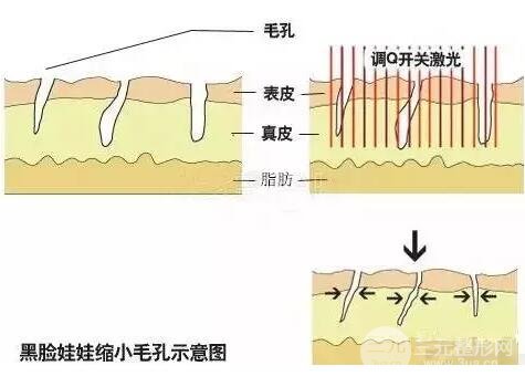 黑臉娃娃收縮毛孔示意圖