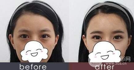 玻尿酸填淚溝會有依賴性嗎？術(shù)后護(hù)理需謹(jǐn)記~