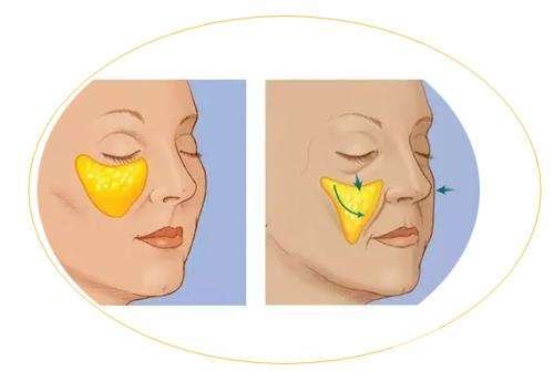 玻尿酸填淚溝會有依賴性嗎？術(shù)后護(hù)理需謹(jǐn)記~