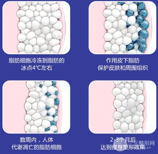 酷塑冷凍溶脂做需要幾次?