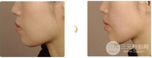 下巴打玻尿酸大概需要多少量？不多，只需要這點(diǎn)！