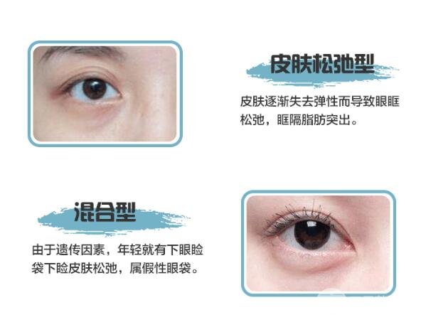 修復(fù)眼袋手術(shù)方式