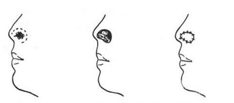 鼻翼缺損修復(fù)手術(shù)的步驟