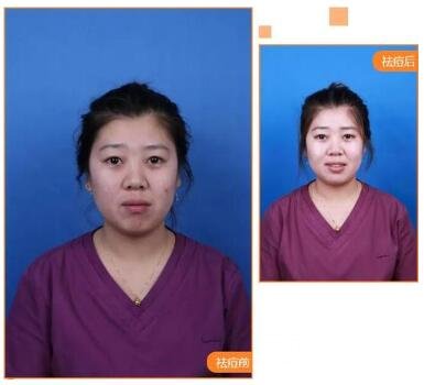 祛痘前的注意事項