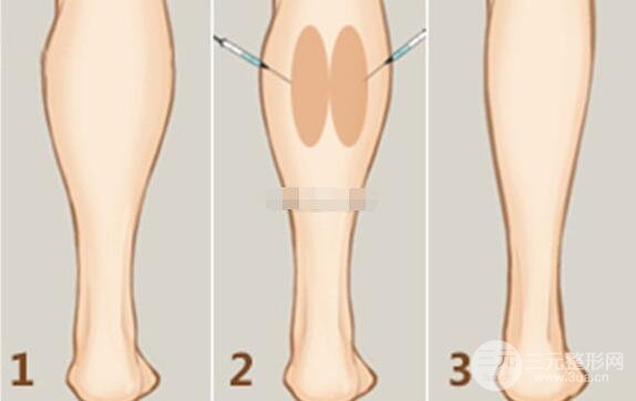 ****瘦腿價格貴不貴？一般多少錢？