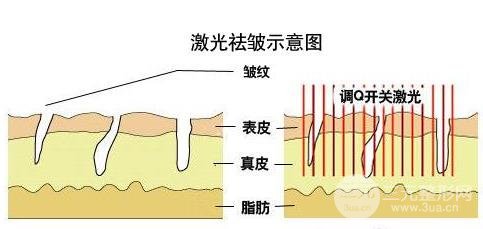 光子療法祛除抬頭紋