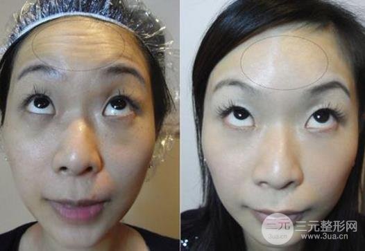 其他方法去除抬頭紋