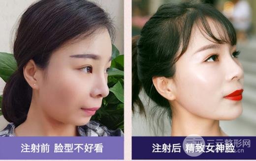 玻尿酸豐下巴維持的時間