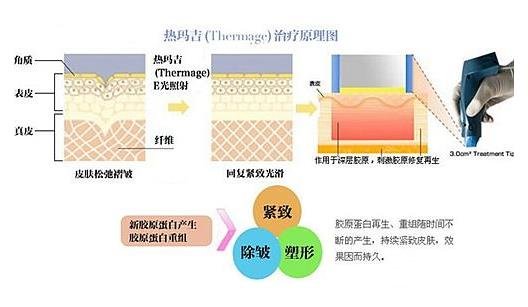 熱瑪吉工作原理
