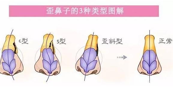 歪鼻矯正手術(shù)原理