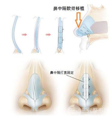 歪鼻矯正手術(shù)原理