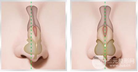 歪鼻手術(shù)的禁忌癥
