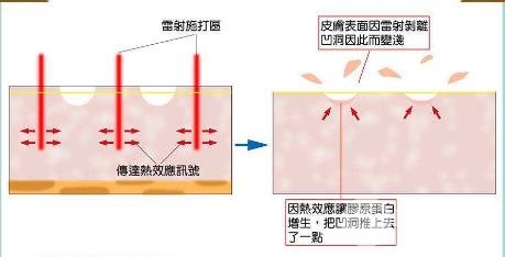 飛梭鐳射原理介紹