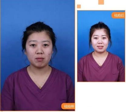 飛梭鐳射的注意事項(xiàng)