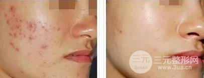 飛梭鐳射的注意事項(xiàng)