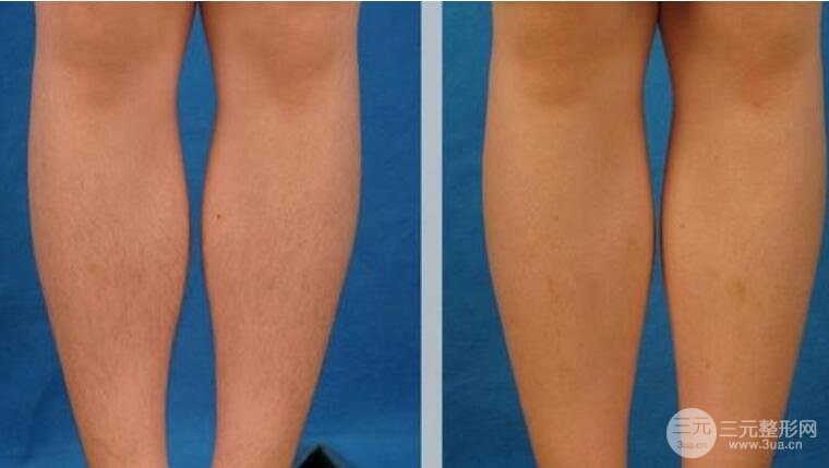 蘭大二院美容科脫毛果圖