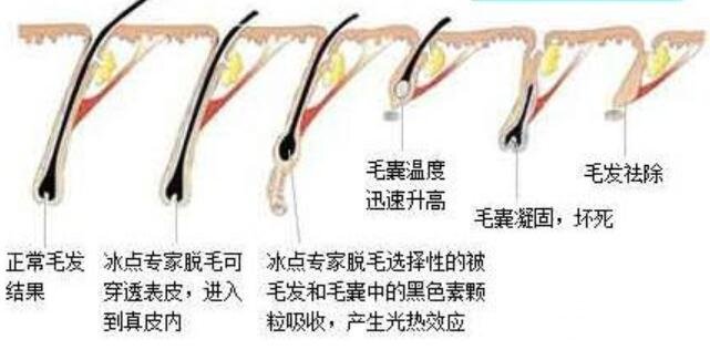 激光脫毛原理圖