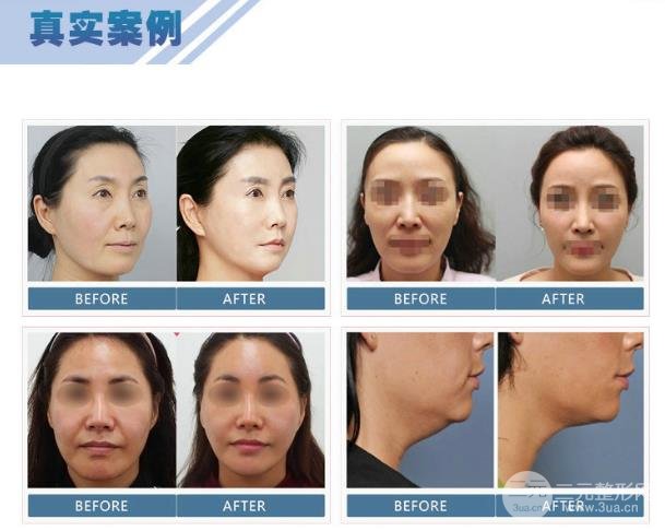 熱拉提美容維持的時(shí)間