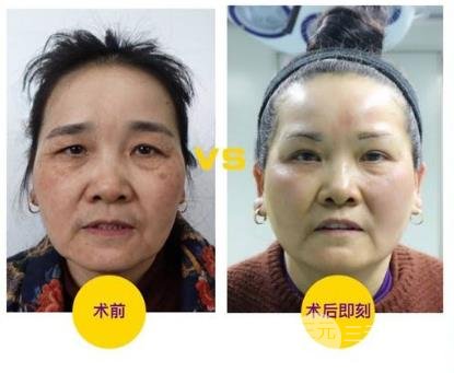 切眉術(shù)會留下疤痕嗎?