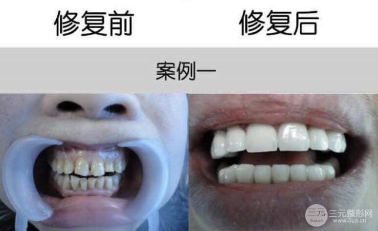 全瓷烤瓷牙案例圖